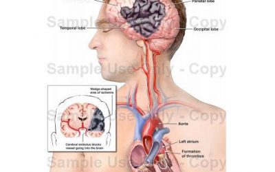 Penyebab Stroke